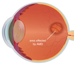 cross section of eye with AMD