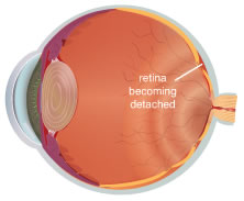 Cross section of an eye with detached retina