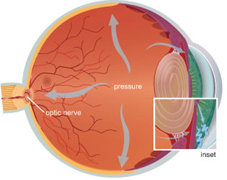 Cross section of eye affect by glaucoma